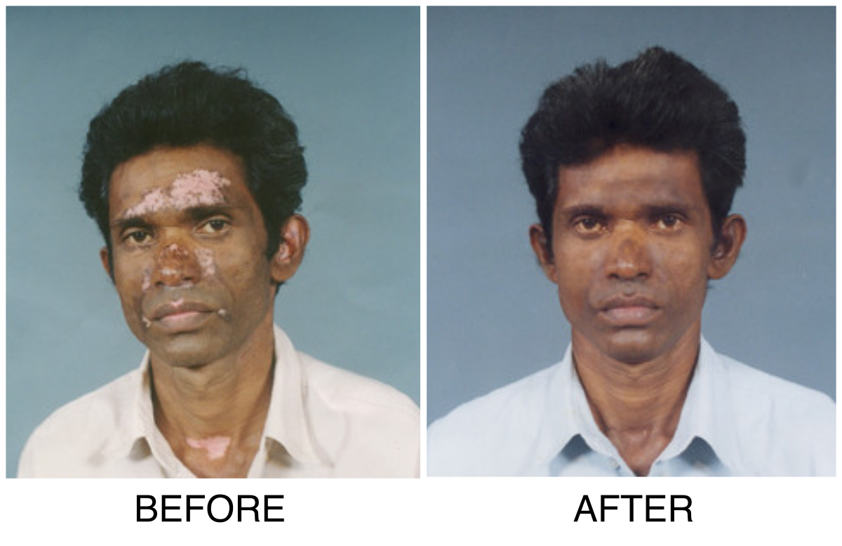 Vitiligo cure before and after